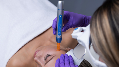 Microneedling-10-tips